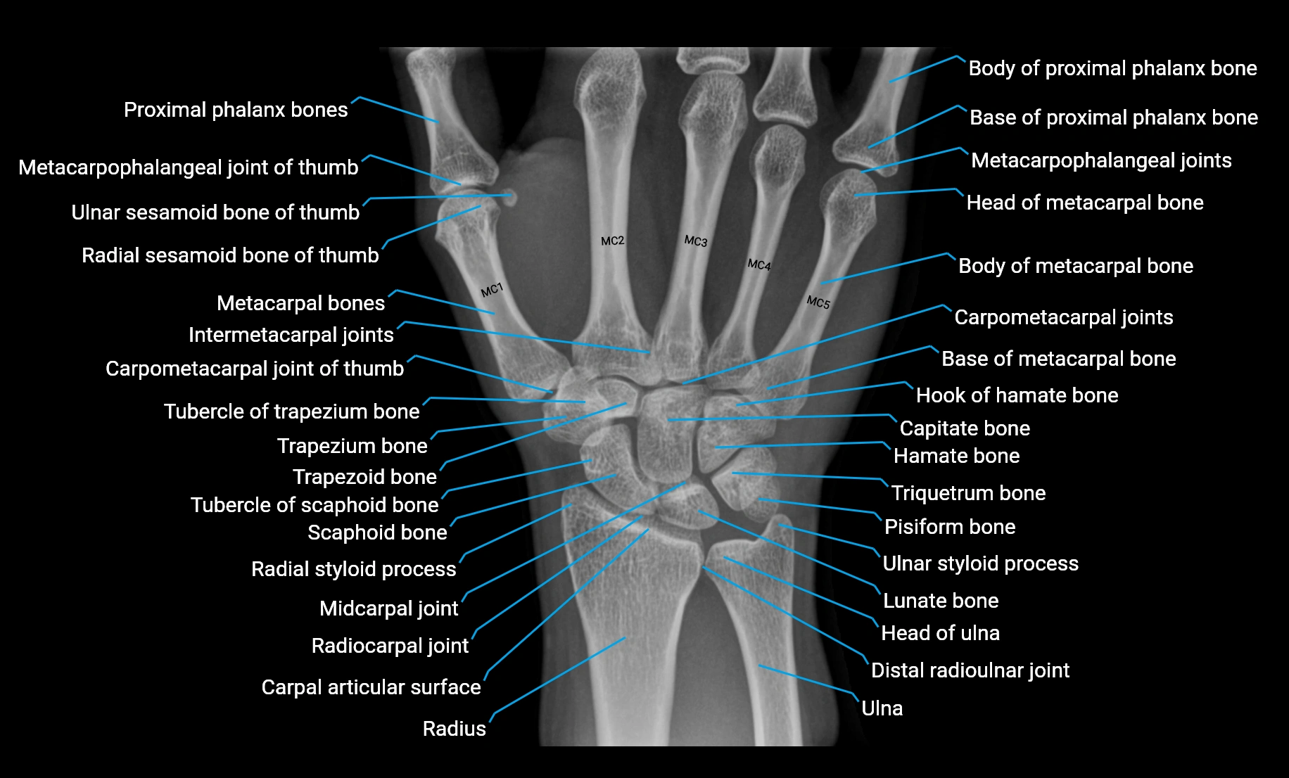 x ray wrist PA anatomy labelled.webp